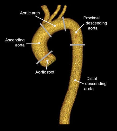 Further imaging tools for aortic acute syndrome