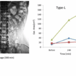 Small intestinal bowel gas and breath hydrogen after ingestion of lactulose