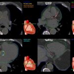 Non-contrast cardiac CT: much more than only calcium scoring!