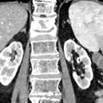 All you need to know about Post Contrast Acute Kidney Injury (AKI)