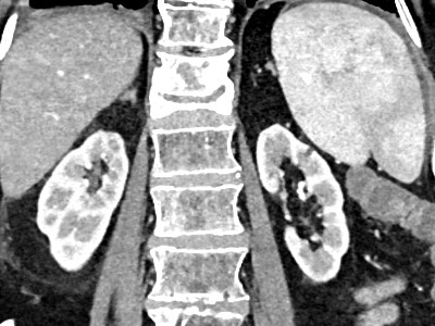 All you need to know about Post Contrast Acute Kidney Injury (AKI)
