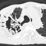 Do you know the scab-like sign?