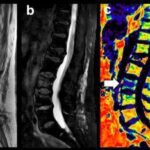 A new tool for the characterization of spine fractures