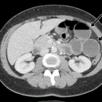 Tricky internal hernias: ten signs to improve your performance