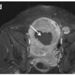 Guidelines for reporting on uterine leiomyoma