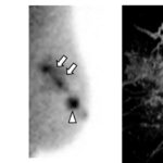 What about breast scintigraphy for predicting malignancy?
