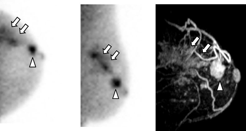 What about breast scintigraphy for predicting malignancy?