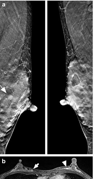 Dense breast: tomosynthesis vs MRI. And the winner is…