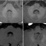 No harm to the paediatric brain after injection of macrocyclic Gadolinium-based agent