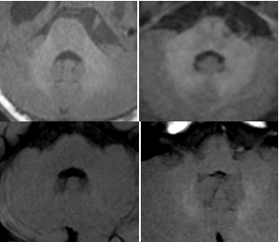 No harm to the paediatric brain after injection of macrocyclic Gadolinium-based agent