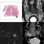 MRI gets closer to genomics in prostate cancer
