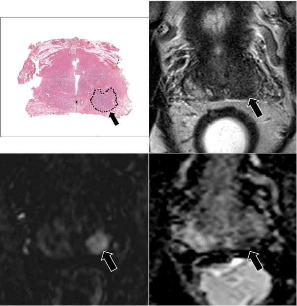 MRI gets closer to genomics in prostate cancer