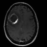 How reliable is MRI for the evaluation of treated high-grade gliomas?