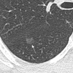 Beware of small ground-glass nodules
