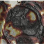 How a machine improves PI-RADS classification in prostatic cancer