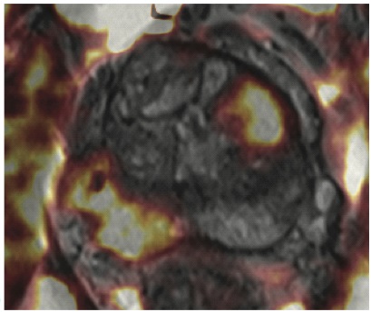 How a machine improves PI-RADS classification in prostatic cancer