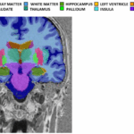 Brain changes in patients with anorexia