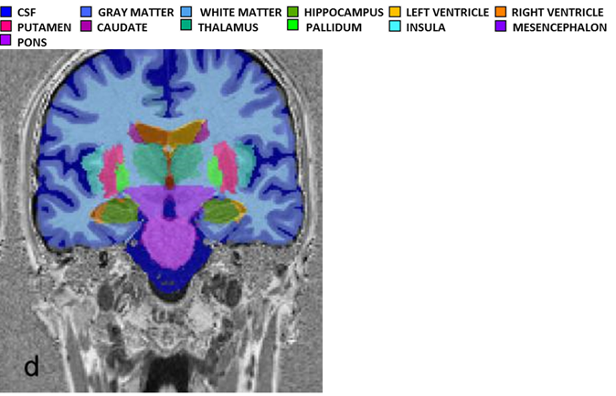 Brain changes in patients with anorexia