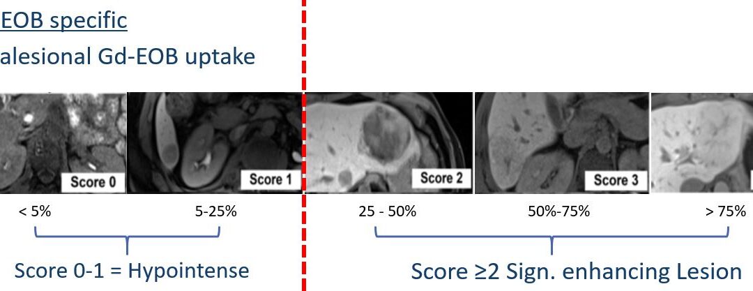 Reply to the Letter to the Editor: “Hepatocellular adenomas: is there additional value in using Gd-EOB-enhanced MRI for subtype differentiation?”