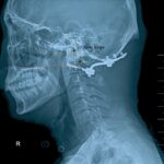Letter to the Editor: “Clivopalate angle: a new diagnostic method for basilar invagination at magnetic resonance imaging”