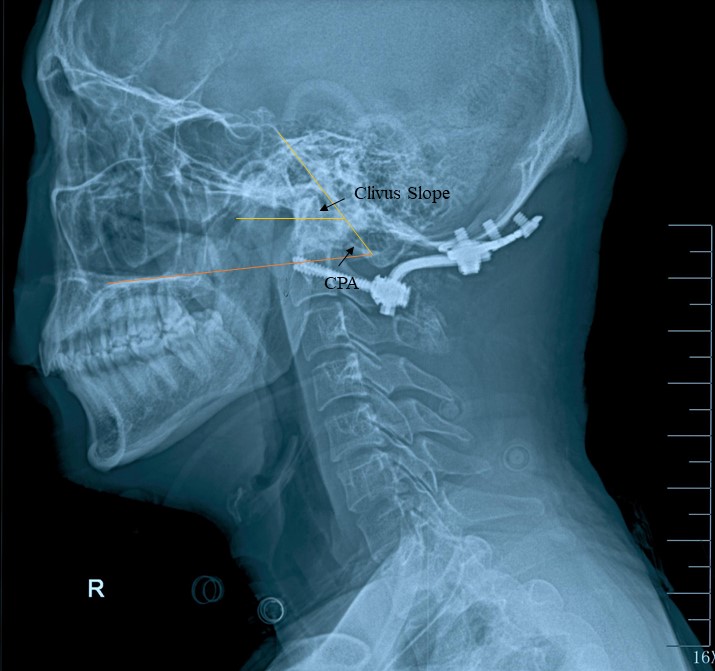 Letter to the Editor: “Clivopalate angle: a new diagnostic method for basilar invagination at magnetic resonance imaging”