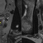 What happens to seminal vesicles after ejaculation?