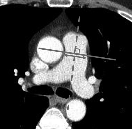Avoiding haemoptysis after transthoracic lung biopsy