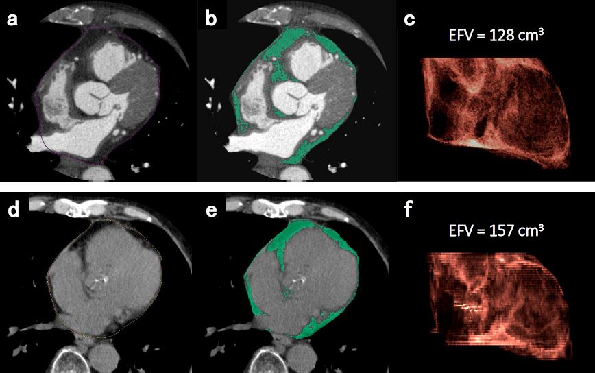 Epicardial fat as an easy predictor of coronary artery disease