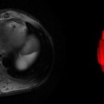 Grading HCC with Radiomics from MRI