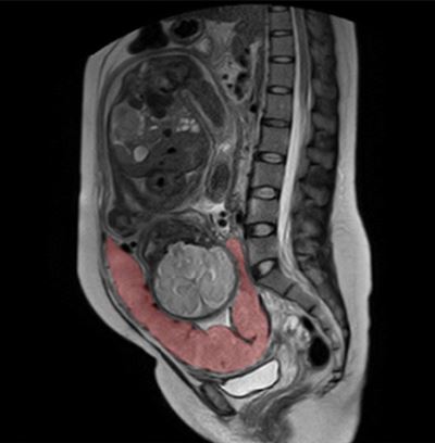 Imaging the placenta: a new frontier?