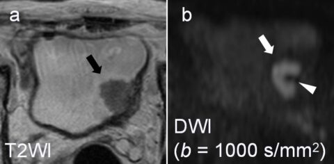 Do you know the Inchworm sign? - European Radiology