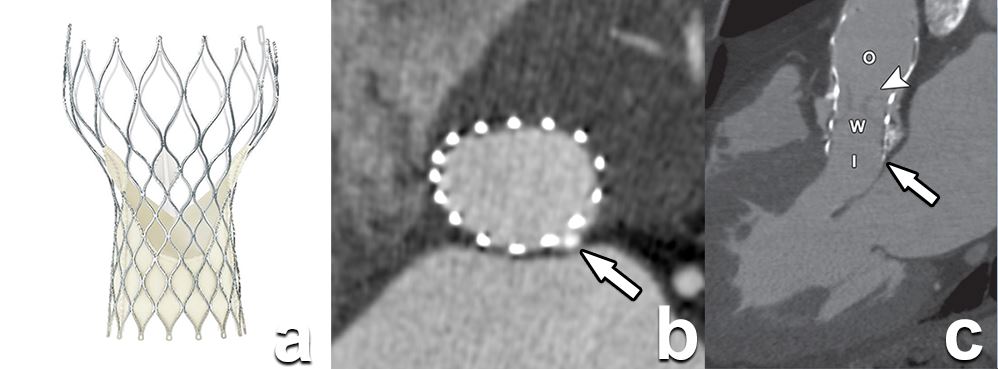 How should we do and report pre-TAVI/TAVR CT/MRI examinations?