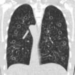 What is the real dose for “Ultra-Low-Dose Chest CT”?