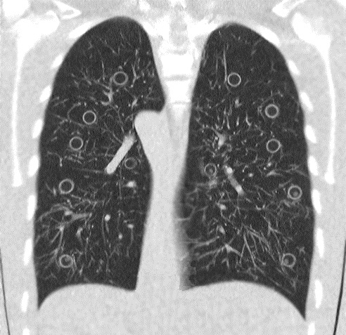 What is the real dose for “Ultra-Low-Dose Chest CT”?