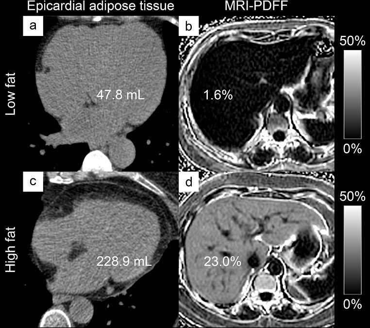 Liver fat and fibrosis are biomarkers of cardio-vascular risk in patients with diabetes mellitus