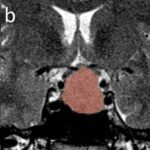 Texture analysis facilitates the follow up of Acromegaly with MRI