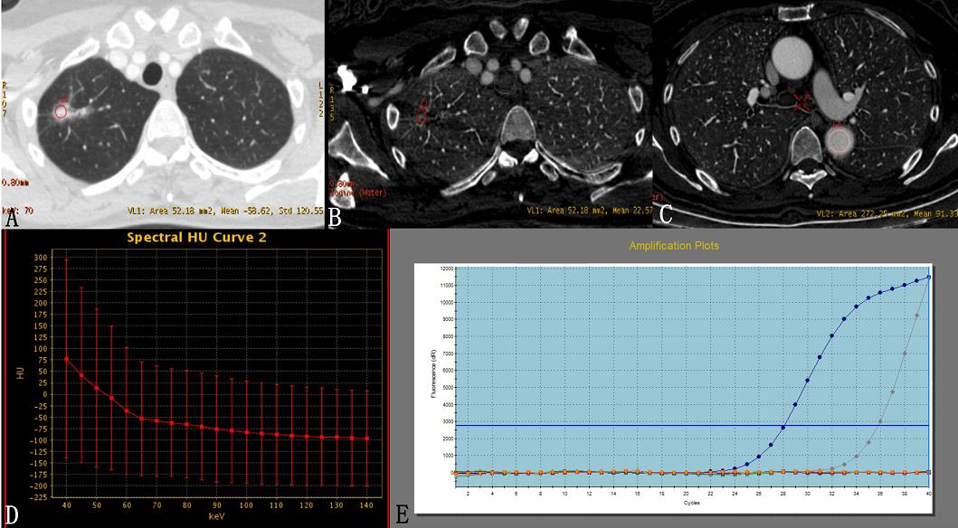 Dual Energy CT and EGFR status in lung cancer
