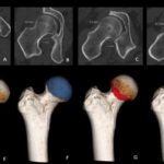 Femoro-acetabular impingement: new developments