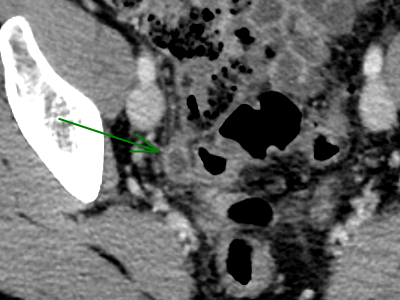 What is the lowest reasonable dose for CT of the appendix? Can we really go lower than 1 mSv?