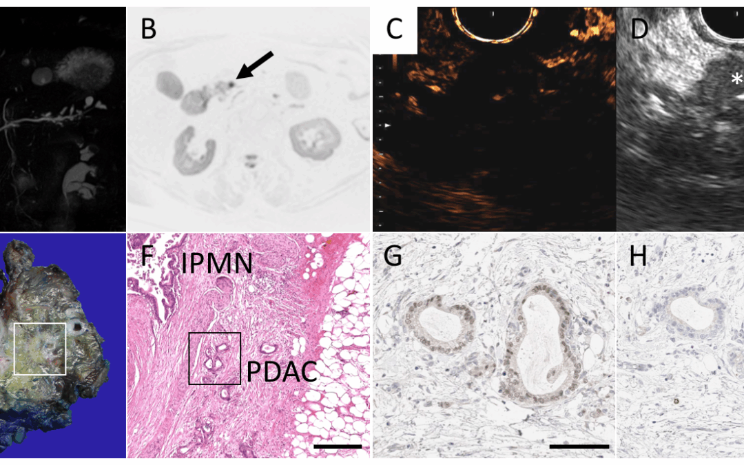 High resolution diffusion weighted-magnetic resonance imaging for risk stratification in intraductal papillary mucinous neoplasia
