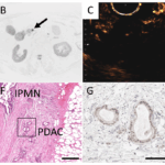 High resolution diffusion weighted-magnetic resonance imaging for risk stratification in intraductal papillary mucinous neoplasia