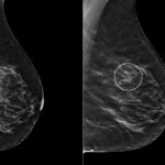 Tomosynthesis increases confidence