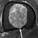 Enchondorma or Chondrosarcoma: not so easy!