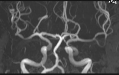 Brain deposition of gadolinium: position statement