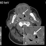 Is Dual-Energy CT beneficial for head and neck imaging?