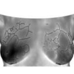 Infrared imaging and breast cancer detection