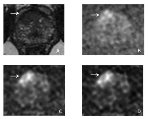 Prostate cancer: Is there a benefit of computed high b-values?