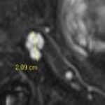 How should we measure IPMN for an optimal follow-up?