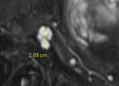 How should we measure IPMN for an optimal follow-up?