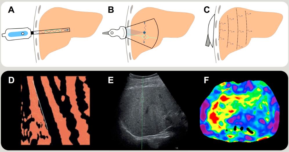 Liver elastography: MR vs US